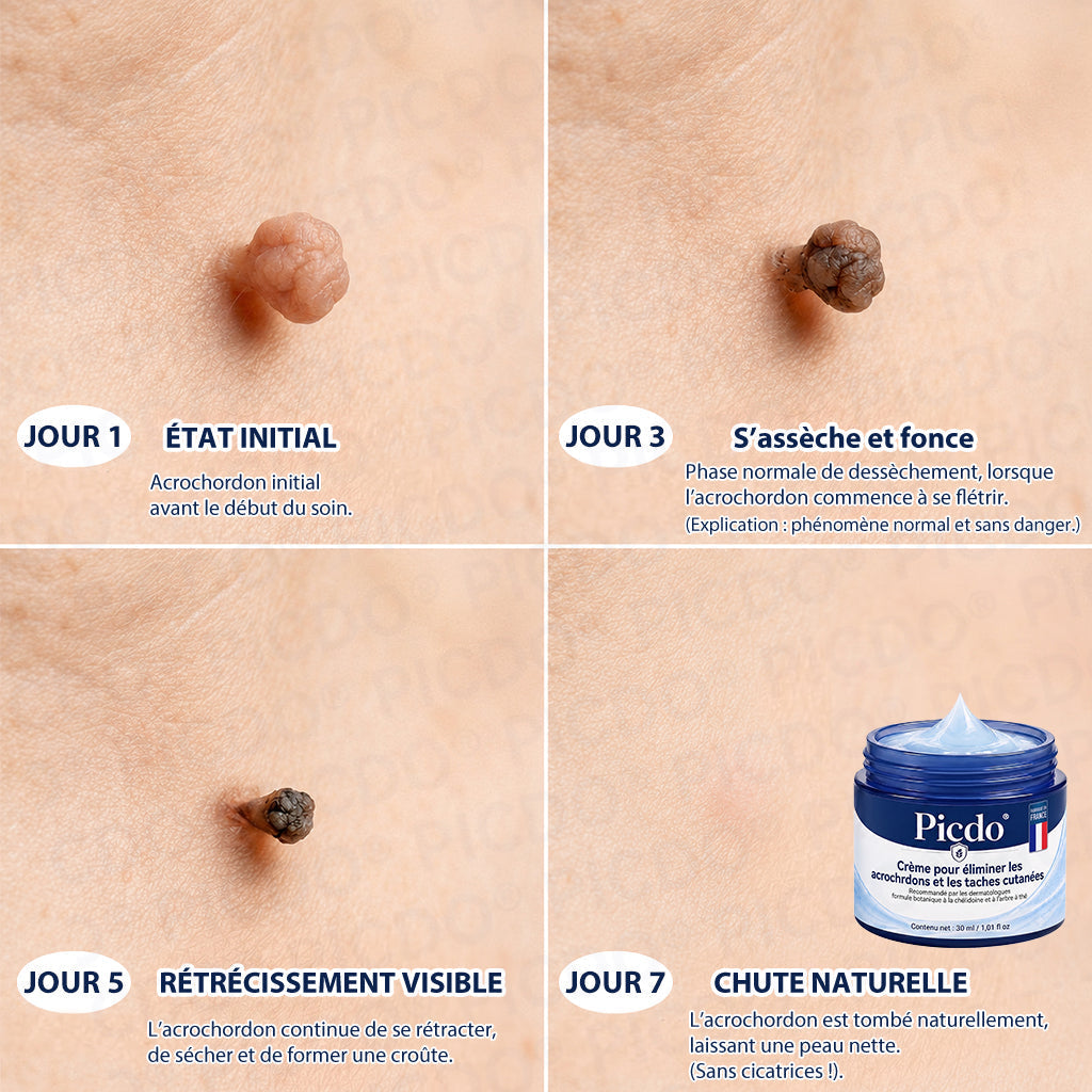 Picdo® Crème Correctrice Acrochordons & Taches — Action visible en 7 jours🌿