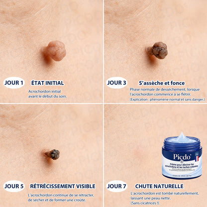 Picdo® Crème Correctrice Acrochordons & Taches — Action visible en 7 jours🌿