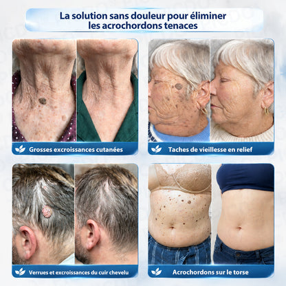 Picdo® Crème Correctrice Acrochordons & Taches — Action visible en 7 jours🌿