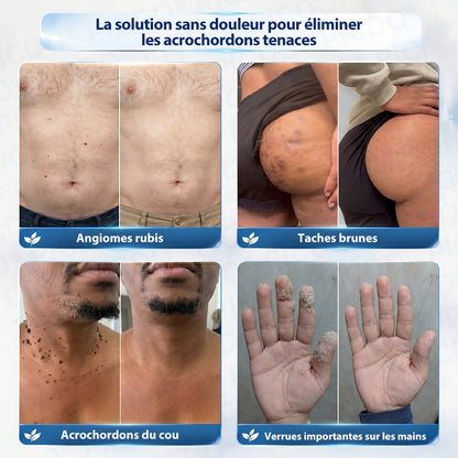 Picdo® Crème Correctrice Acrochordons & Taches — Action visible en 7 jours🌿
