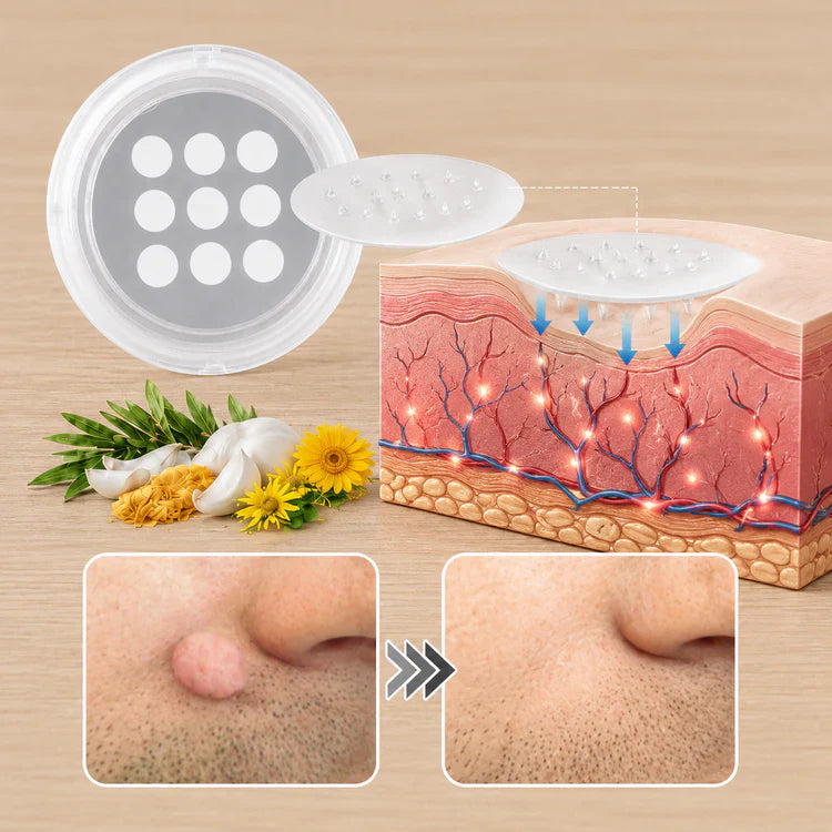 Curalona® Patch 2-en-1 à Micro-aiguilles & Hydrocolloïde 🍀 | Aide à éliminer les grains de beauté en relief, l’acné, les verrues planes et les acrochordons | Patchs invisibles pour le visage et le corps