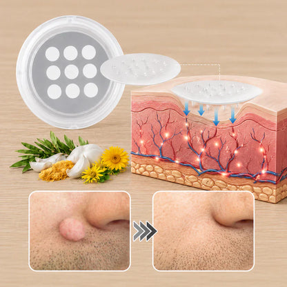 Curalona® Patch 2-en-1 à Micro-aiguilles & Hydrocolloïde 🍀 | Aide à éliminer les grains de beauté en relief, l’acné, les verrues planes et les acrochordons | Patchs invisibles pour le visage et le corps