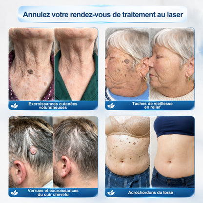 Boutique officielle de la marque |🩹𝐏i𝐜𝐝o® 7 Jours Effaceur de taches et d’excroissances cutanées(Zéro douleur, zéro cicatrice – Roller)👍