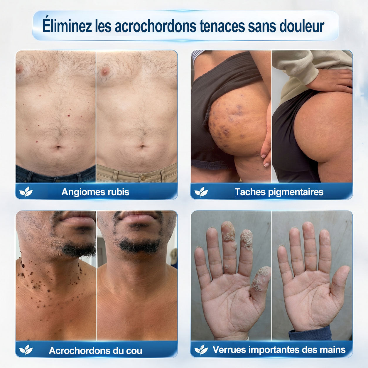 Boutique officielle de la marque |🩹𝐏i𝐜𝐝o® 7 Jours Effaceur de taches et d’excroissances cutanées(Zéro douleur, zéro cicatrice – Roller)👍