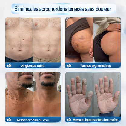Boutique officielle de la marque |🩹𝐏i𝐜𝐝o® 7 Jours Effaceur de taches et d’excroissances cutanées(Zéro douleur, zéro cicatrice – Roller)👍