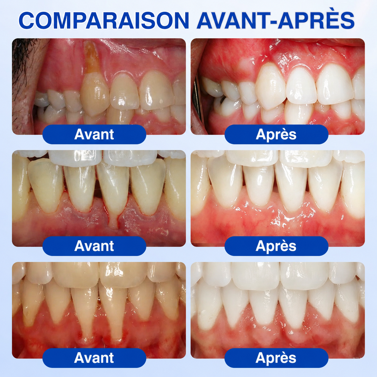 🦷✨ 𝑷𝒖𝒓𝒆𝒍𝒐𝒓𝒂® 𝑮𝒖𝒎𝑹𝒆𝒗𝒊𝒗𝒆 𝑮𝒆𝒍 𝒅𝒆 𝑹é𝒑𝒂𝒓𝒂𝒕𝒊𝒐𝒏 𝑷𝒂𝒓𝒐𝒅𝒐𝒏𝒕𝒂𝒍𝒆