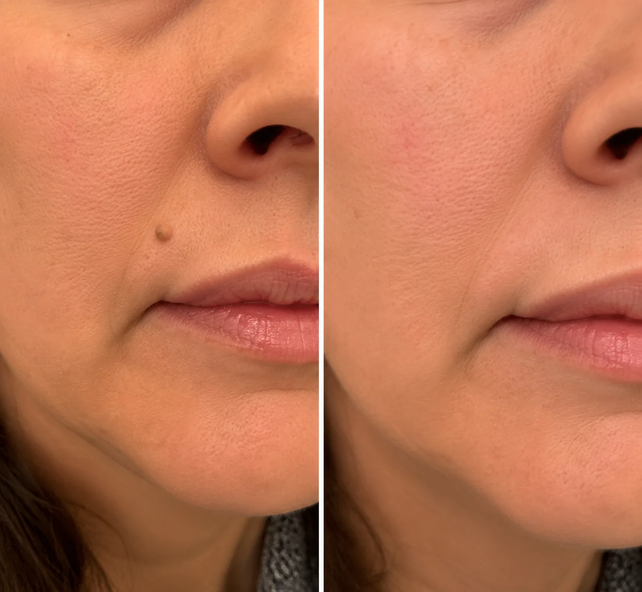 Curalona® Patch 2-en-1 à Micro-aiguilles & Hydrocolloïde 🍀 | Aide à éliminer les grains de beauté en relief, l’acné, les verrues planes et les acrochordons | Patchs invisibles pour le visage et le corps