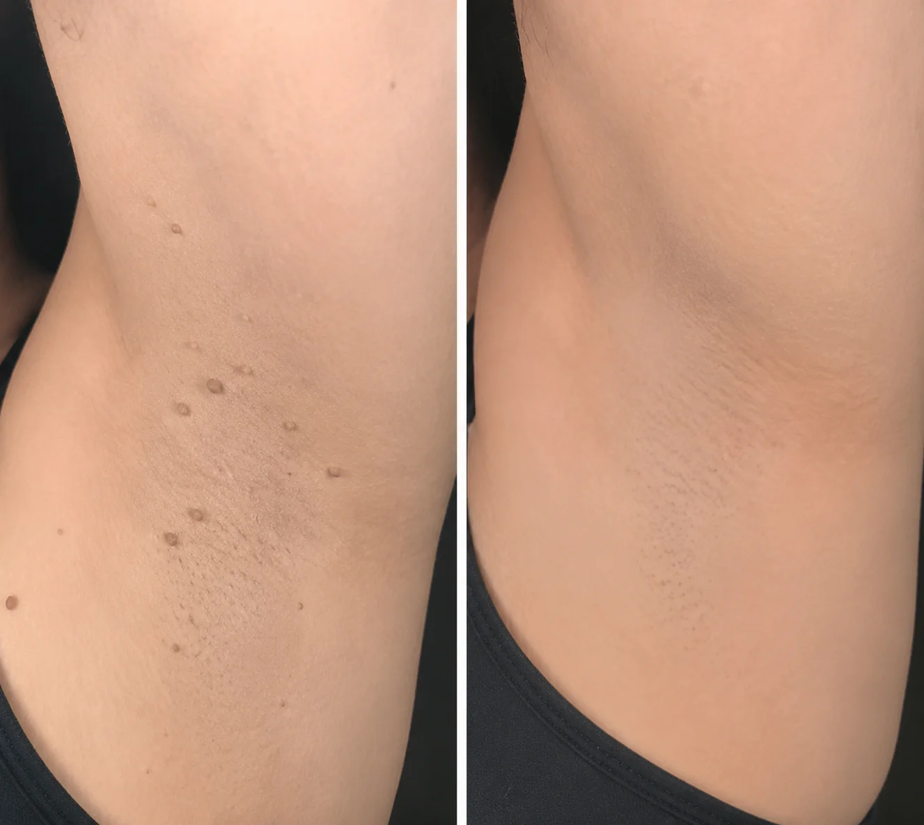 Curalona® Patch 2-en-1 à Micro-aiguilles & Hydrocolloïde 🍀 | Aide à éliminer les grains de beauté en relief, l’acné, les verrues planes et les acrochordons | Patchs invisibles pour le visage et le corps