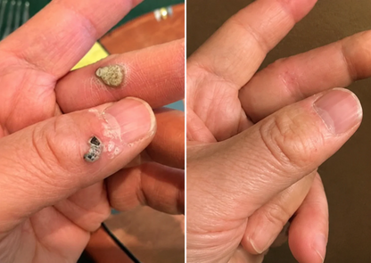 Curalona® Patch 2-en-1 à Micro-aiguilles & Hydrocolloïde 🍀 | Aide à éliminer les grains de beauté en relief, l’acné, les verrues planes et les acrochordons | Patchs invisibles pour le visage et le corps